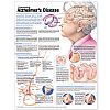Understanding Alzheimer’s Disease Anatomical Chart - att förstå Alzheimer affisch 50x65cm laminerad