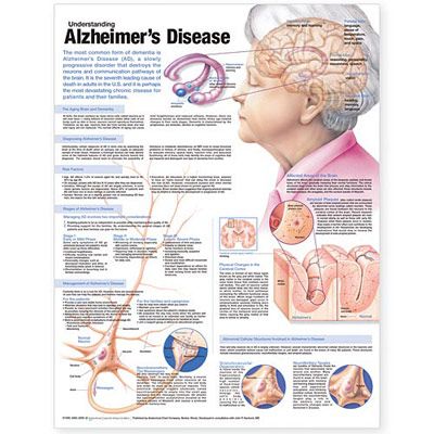 Understanding Alzheimer’s Disease Anatomical Chart - att förstå Alzheimer affisch 50x65cm papper