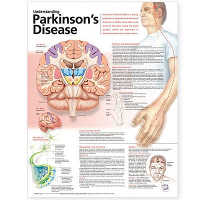 Understanding Parkinson’s Disease Anatomical Chart - att förstå Parkinsson affisch 50x65cm laminerad