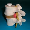 Anatomisk modell lumbar vertebral kotor med diskbråck